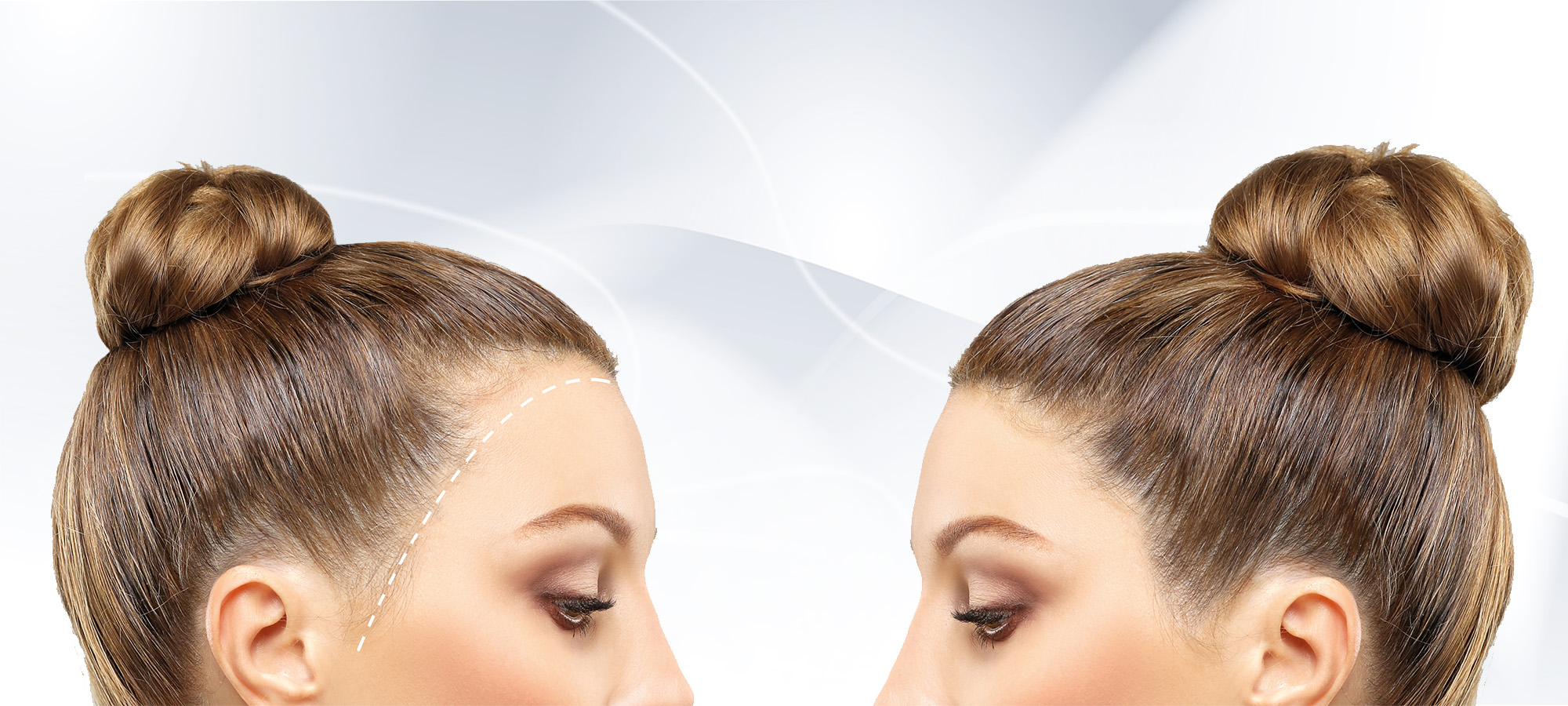 Haar-Transplantation-bei-Frauen