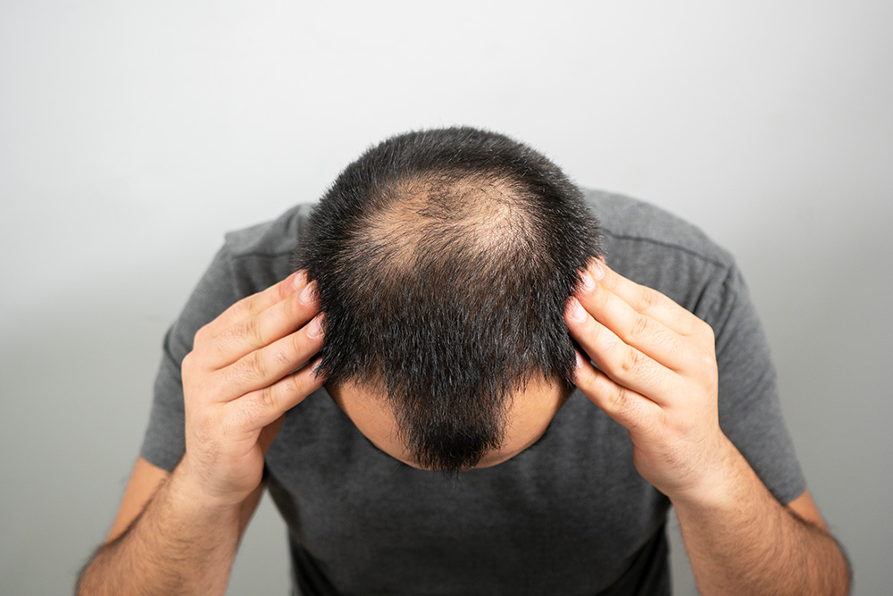 Haartransplantation-ohne-Rasur-Mann