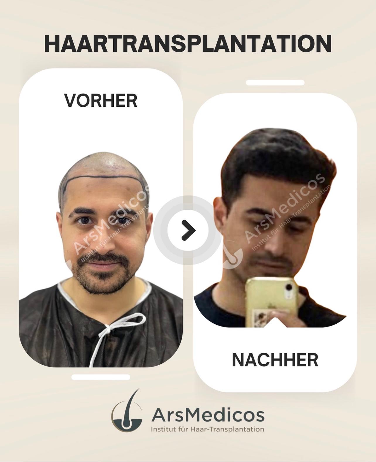 ArsMedicos-Haaartransplantation-Beispiel-Songuel-Alcin