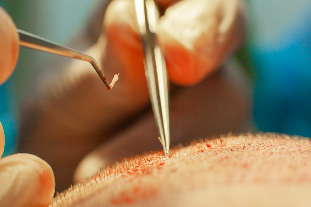 Haartransplantation-ArsMedicos-Hybride-Transplantation-FUE-DHI