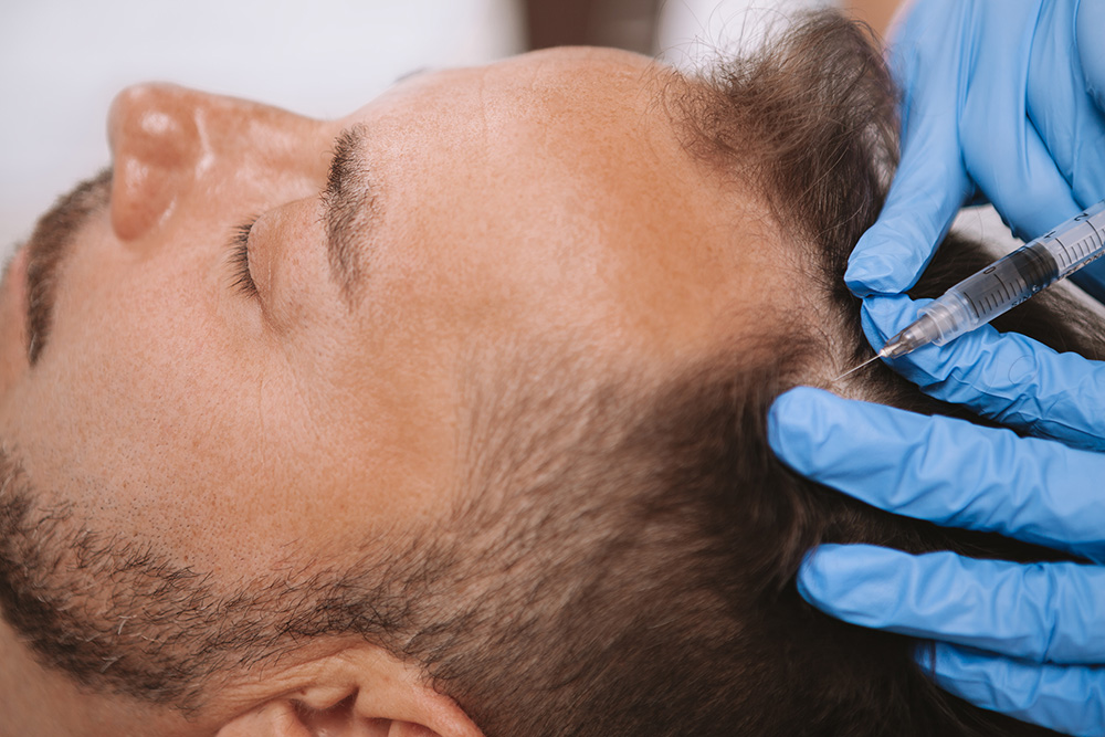 Haartransplantation-FUE-DHI-Technik-Hybride-Haartransplantation