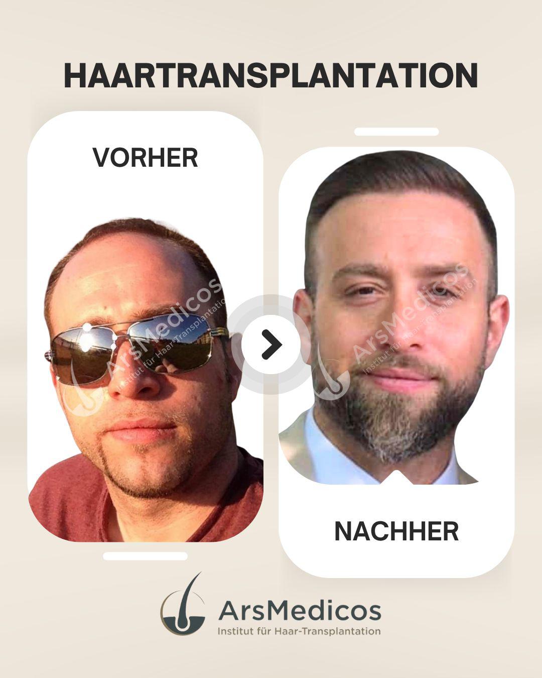 ArsMedicos-Haartransplantation-Reutlingen-Beispiel-Vorher-Nachher-6