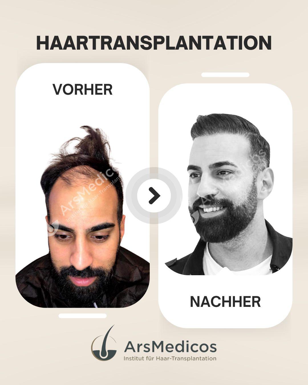 ArsMedicos-Haartransplantation-Reutlingen-Vorher-Nachher-Beispiel-5